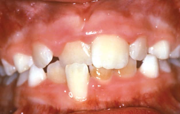 Crossbite Shelly Orthodontics in Fort Dodge, Carroll, and Algona, IA