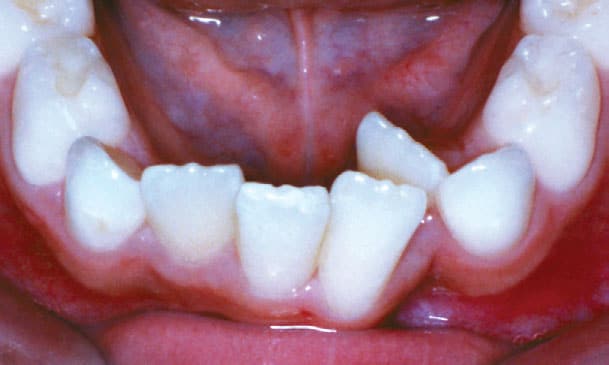 Crowding Shelly Orthodontics in Fort Dodge, Carroll, and Algona, IA