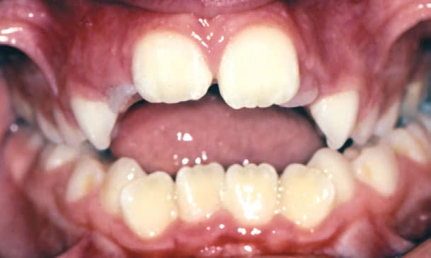 Open Bite Shelly Orthodontics in Fort Dodge, Carroll, and Algona, IA