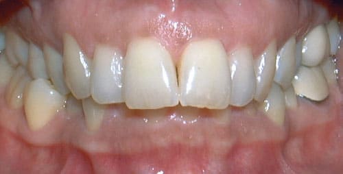 Overbite Shelly Orthodontics in Fort Dodge, Carroll, and Algona, IA