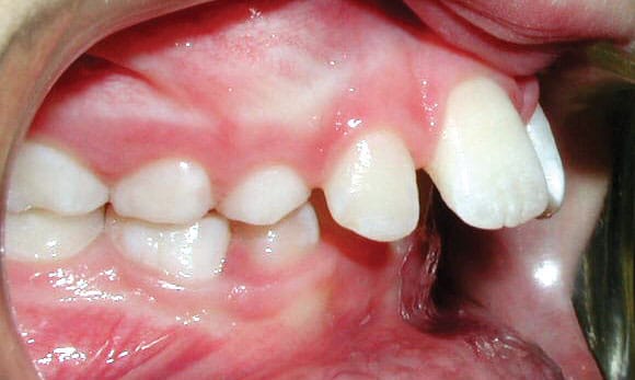 Protrusion Shelly Orthodontics in Fort Dodge, Carroll, and Algona, IA