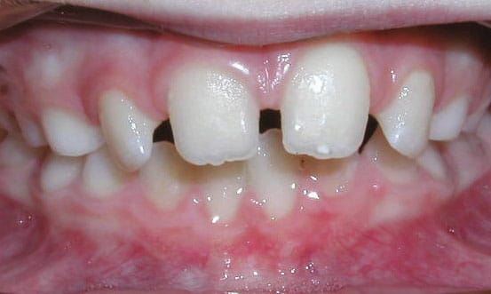 Spacing Shelly Orthodontics in Fort Dodge, Carroll, and Algona, IA