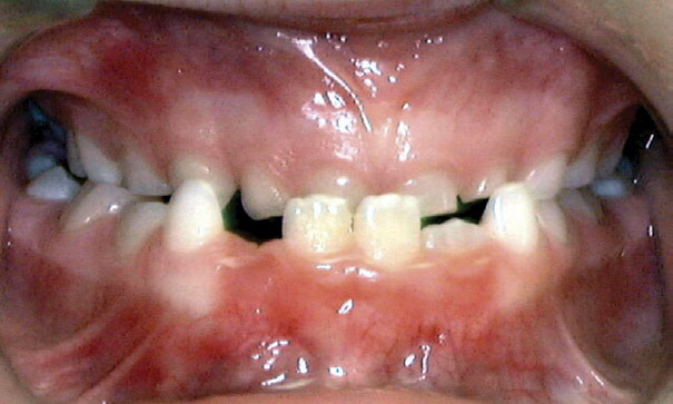 Underbite Shelly Orthodontics in Fort Dodge, Carroll, and Algona, IA